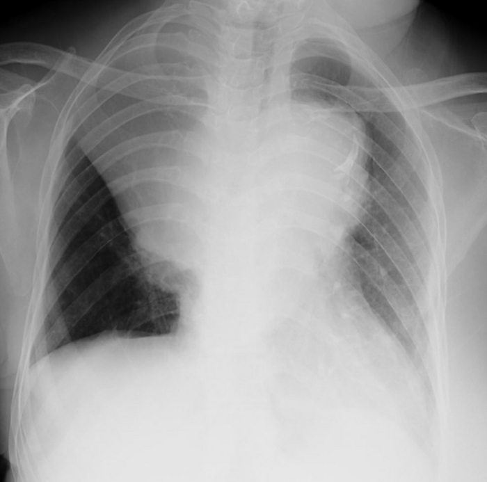 Golden S sign, X ray Chest X ray golden S sign, its associated with a central carcinoma producing the mass and lung collapse  atelectasis ., by RAJAAISYA SCIENCE PHOTO LIBRARY