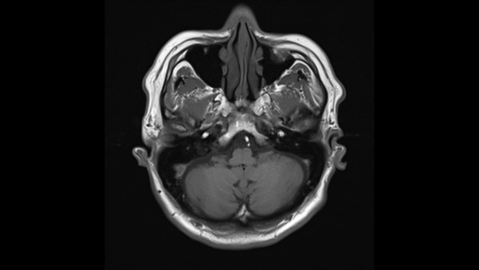 Healthy brain, MRI scan Healthy brain, magnetic resonance imaging  MRI  scan. The front of the head is at top. This is a view at the base of the brain. The dark areas at top are the maxillary sinuses. The two bright dots at centre right and left are the internal carotid arteries. At bottom is the cerebellum of the brain, which controls balance, posture and muscle coordination. For a series of slices through this brain see F036 5751 to F036 5762., by RAJAAISYA SCIENCE PHOTO LIBRARY