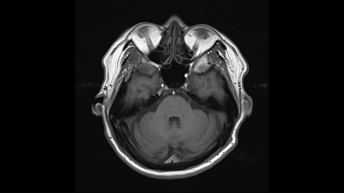 Healthy brain, MRI scan Healthy brain, magnetic resonance imaging  MRI  scan. The front of the head is at top. This is a view at the level of the eyes  white, at top . The dark area at upper centre is the sphenoid sinus. The two bright dots at centre right and left are the internal carotid arteries, with the basilar artery below them at centre. At centre are the pons, part of the brainstem that are involved in the control of sleep and arousal. At bottom is the cerebellum, which controls balance, posture and muscle coordination. For a series of slices through this brain see F036 5751 to F036 5762., by RAJAAISYA SCIENCE PHOTO LIBRARY