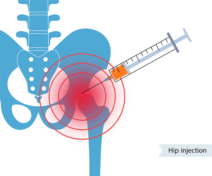 Hip joint injection, illustration Hip joint injection, illustration., by PIKOVIT   SCIENCE PHOTO LIBRARY