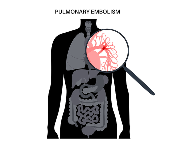 Pulmonary embolism, illustration Pulmonary embolism, illustration., by PIKOVIT   SCIENCE PHOTO LIBRARY
