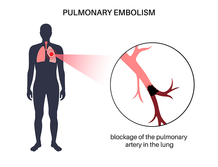 Pulmonary embolism, illustration Pulmonary embolism, illustration., by PIKOVIT   SCIENCE PHOTO LIBRARY