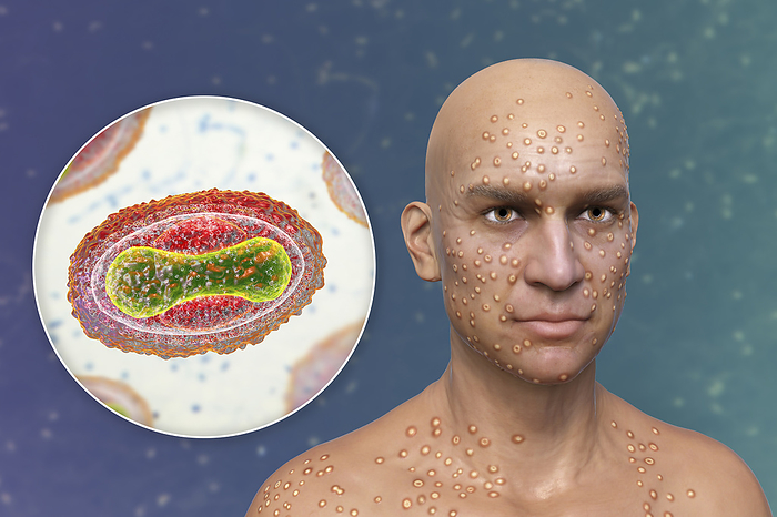 Smallpox virus infection, illustration Patient with smallpox  variola  and close up of a smallpox virus, illustration. Smallpox is a disease that causes fever and often death. It was eradicated after a worldwide effort in the 1970s, but strains exist in research laboratories. Similar skin lesions can be found in currently available viruses from the Poxviridae family, such as monkeypox, which also have the same virion morphology., by KATERYNA KON SCIENCE PHOTO LIBRARY