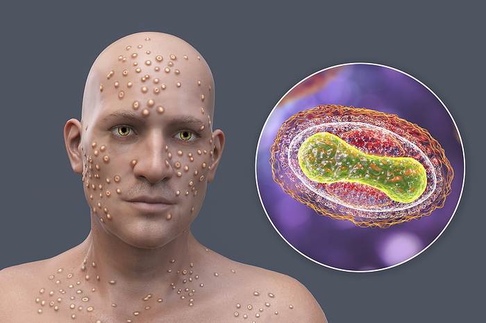 Smallpox virus infection, illustration Patient with smallpox  variola  and close up of a smallpox virus, illustration. Smallpox is a disease that causes fever and often death. It was eradicated after a worldwide effort in the 1970s, but strains exist in research laboratories. Similar skin lesions can be found in currently available viruses from the Poxviridae family, such as monkeypox, which also have the same virion morphology., by KATERYNA KON SCIENCE PHOTO LIBRARY