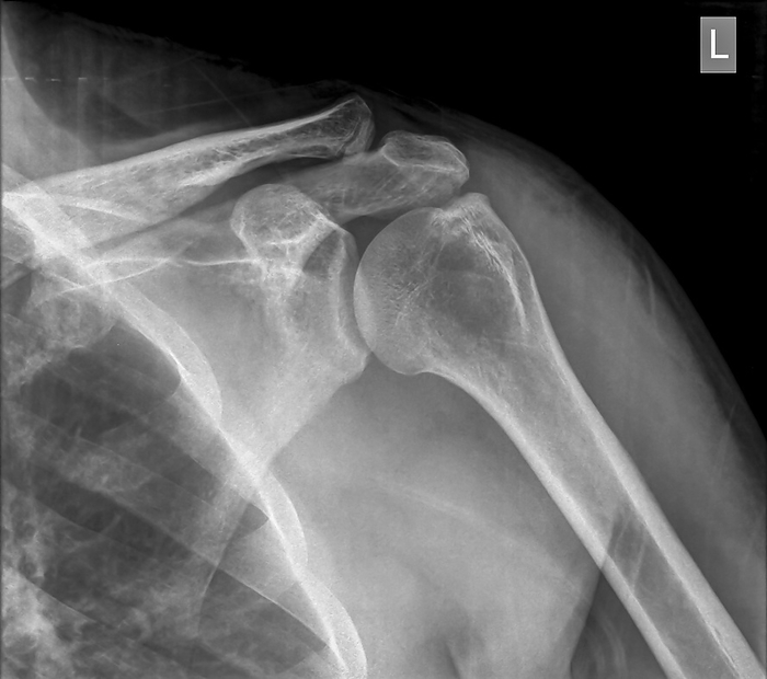 Fractured clavicle, X ray X ray of a 40 year old male patient with a fractured clavicle  collar bone . Front view., by PHOTOSTOCK ISRAEL SCIENCE PHOTO LIBRARY