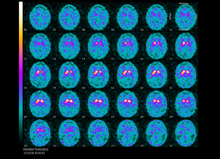 Dopamine transporter PET brain scans Dopamine active transporter  DAT  with positron emission tomography  PET  scans of the brain of an 85 year old male patient. This scan is used to diagnose Parkinson s disease when a clinical assessment is not conclusive. It uses a radioactive tracer that binds to dopamine transporter molecules found on dopamine neurones  nerve cells  in the brain. Most of the dopamine neurones are in a central region of the brain called the striatum. In patients with Parkinson s disease only a small area of the striatum will be highlighted by the tracer as it is the death of the dopaminergic neurones that leads to the symptoms of Parkinson s disease. These symptoms include tremor, muscular rigidity, poor balance and depression., by DR P. MARAZZI SCIENCE PHOTO LIBRARY