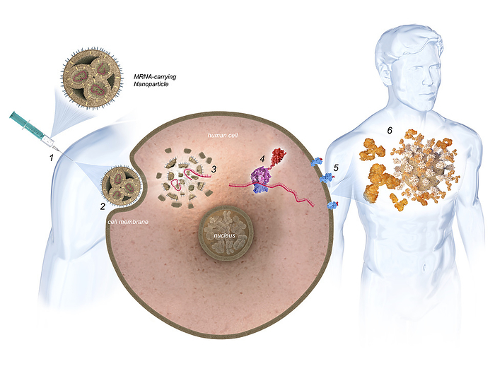 mRNA vaccine, illustration mRNA vaccine, illustration. Messenger RNA  mRNA  vaccines are given in the upper arm muscle 1 . Lipid nanoparticles  LNPs  serve as a carrier that delivers the mRNA to the  cell  2, 3 . Once in the cytoplasm, the mRNA instructs the cell s machinery to produce a harmless piece of the pathogen, which is displayed on the cells surface  4, 5 . The immune system then recognizes the unfamiliar protein and produces antibodies against it. These antibodies are then able to fight off a real infection  6 ., by SIMONE ALEXOWSKI   SCIENCE PHOTO LIBRARY