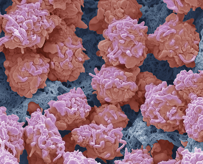Inflammation, SEM Inflammation. Coloured scanning electron micrograph  SEM  of leucocytes  white blood cells  in urine from a patient with acute bacterial prostatitis. Acute bacterial prostatitis  ABP  is thought to result from an ascending urethral infection or reflux of infected urine into the prostatic ducts. Bacteria that cause prostatitis are similar in type and incidence to those commonly causing urinary tract infections. Although common strains of Escherichia coli predominate, other species may be present including, Klebsiella, Proteus, Enterobacter, Pseudomonas, and Serratia. ABP is usually diagnosed by the increased presence of bacteria and white blood cells in the urine. Antibiotics are usually use to treat acute bacterial prostatitis. Magnification: x2500 when printed 10 centimetres wide., by STEVE GSCHMEISSNER SCIENCE PHOTO LIBRARY