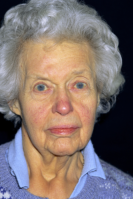 Jaundice editorial use only   Jaundice. 81 year old woman suffering from drug induced jaundice. Yellowing of the white  sclera  of the eyes and the surrounding skin can be seen. Jaundice is not a disease in itself, but is a symptom of many disorders of the liver and biliary system. Jaundice caused by drugs, which are treating other conditions, requires constant medical attention. The yellowing symptoms of jaundice are caused by an excess of bilirubin, a bile pigment, in the blood.