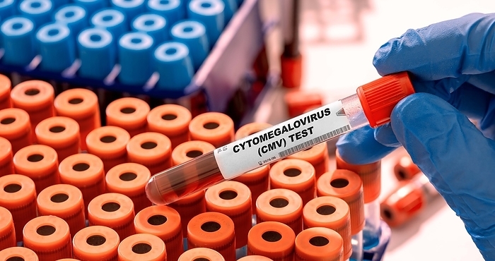 Cytomegalovirus blood test, conceptual image Cytomegalovirus  CMV  blood test, conceptual image., by WLADIMIR BULGAR SCIENCE PHOTO LIBRARY