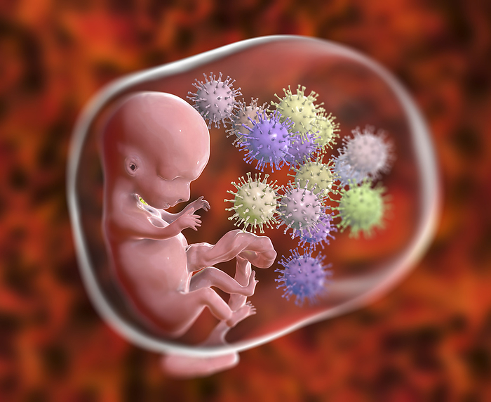 Transplacental transmission of Cytomegalovirus, illustration Transplacental transmission of Cytomegalovirus  CMV  to a human embryo, conceptual computer illustration., by KATERYNA KON SCIENCE PHOTO LIBRARY
