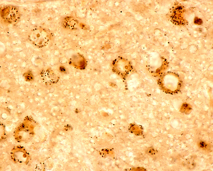 Lysosomes in nerve cell, light micrograph Light micrograph using the Gomori method to detect acid phosphatase showing lysosomes  black  in the cell body of neurons. Lysosomes are important for normal function as highlighted by insights from human genetics that link lysosome dysfunction to a wide range of both rare and common neurological diseases., by JOSE CALVO   SCIENCE PHOTO LIBRARY