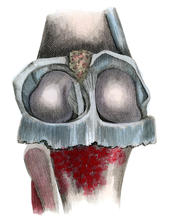 Knee joint, illustration Illustration of a posterior knee joint. Between the femoral condyles is the posterior cruciate ligament  PCL  with the anterior cruciate ligament ligament  ACL  partly visible. Menisci are load bearing, reduce friction and create a concave surface for femoral movement. The ACL prevents excessive posterior displacement of the femur. The PCL prevents excessive anterior displacement of the femur. From Lizars, J. 1823 A system of anatomical plates of the human body. W. H.Lizars, Edinburgh., by MICROSCAPE SCIENCE PHOTO LIBRARY