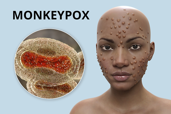 Monkeypox infection, illustration Patient with monkeypox infection, computer illustration. Monkeypox is a zoonotic virus from the Poxviridae family that causes monkeypox, a pox like disease. This virus, which is found near rainforests in Central and West Africa causes disease in humans and monkeys, although its natural hosts are rodents. It is capable of human to human transmission. In humans it causes fever, swollen glands and a rash of fluid filled blisters. It is fatal in 10 per cent of cases., by KATERYNA KON SCIENCE PHOTO LIBRARY