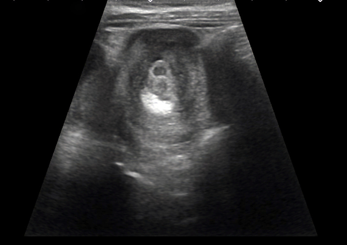 Intussusception of the intestines, ultrasound scan Ultrasound scan of the abdomen of a 1 year old boy with intussusception of the intestine  bowel . Intussusception is a condition in which part of the intestines telescopes into an adjacent part. It causes abdominal pain, nausea and bleeding from the rectum, and the condition is fatal if not corrected., by RAJAAISYA SCIENCE PHOTO LIBRARY