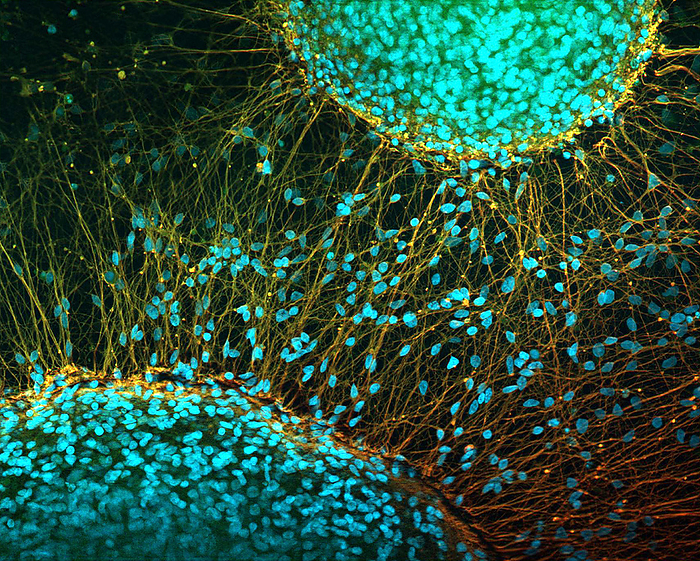 Stem cell derived neurons, light micrograph Fluorescence light micrograph of nerve cells  neurons  that have been derived from induced pluripotent stem cells  IPS . Pluripotent stem cells are able to differentiate into any of the 200 cell types in the human body. The type of cell they mature into depends upon the biochemical signals received by the immature cells. This ability makes them a potential source of cells to repair damaged tissue in diseases such as Parkinson s and insulin dependent diabetes., by IKELOS GmbH Dr. Christopher B. Jackson Science Photo Library
