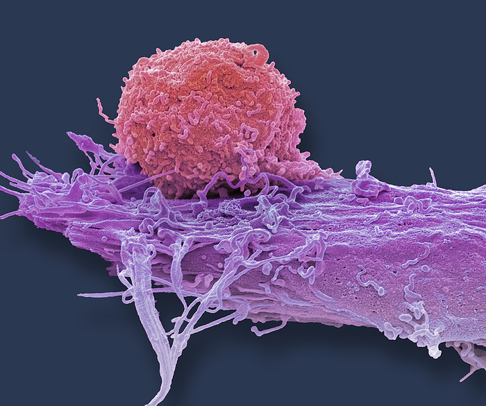CAR T cell therapy, SEM CAR T cell therapy. Coloured scanning electron micrograph  SEM  of a T cell   red  and a brain cancer cell   oligodendroglioma . CAR T cell therapy involves producing large quantities of specialised T cells on an individual basis for each patient. T cells are extracted from a patient s blood sample and reprogrammed to recognise a specific target protein on the patient s tumour cells. To achieve this, the T cells are infected with a harmless virus, which inserts a gene into the T cell s DNA that causes the T cell to produce a receptor on its surface that recognises a specific tumour protein. Large quantities of the reprogrammed T cells are grown in the lab before being injected back into the patient where they seek out the target protein on brain cancer cells and attack them. Magnification: x3600 when printed at 10 centimetres wide., by STEVE GSCHMEISSNER SCIENCE PHOTO LIBRARY