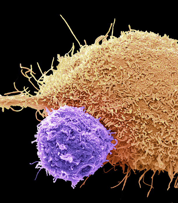 CAR T cell therapy, SEM CAR T cell therapy. Coloured scanning electron micrograph  SEM  of a T cell   purple  and a kidney cancer cell. CAR T cell therapy involves producing large quantities of specialised T cells on an individual basis for each patient. T cells are extracted from a patient s blood sample and reprogrammed to recognise a specific target protein on the patient s tumour cells. To achieve this, the T cells are infected with a harmless virus, which inserts a gene into the T cell s DNA that causes the T cell to produce a receptor on its surface that recognises a specific tumour protein. Large quantities of the reprogrammed T cells are grown in the lab before being injected back into the patient where they seek out the target protein on kidney cancer cells and attack them. Magnification: x2400 when printed 10 centimetres wide., by STEVE GSCHMEISSNER SCIENCE PHOTO LIBRARY