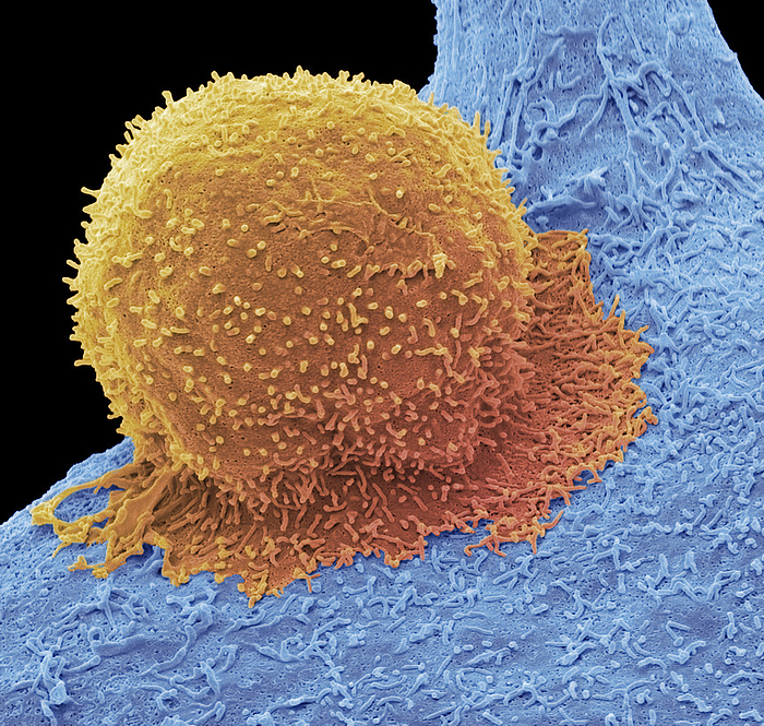 CAR T cell therapy, SEM CAR T cell therapy. Coloured scanning electron micrograph  SEM  of a T cell  orange  and a breast cancer cell. CAR T cell therapy involves producing large quantities of specialised T cells on an individual basis for each patient. T cells are extracted from a patient s blood sample and reprogrammed to recognise a specific target protein on the patient s tumour cells. To achieve this, the T cells are infected with a harmless virus, which inserts a gene into the T cell s DNA that causes the T cell to produce a receptor on its surface that recognises a specific tumour protein. Large quantities of the reprogrammed T cells are grown in the lab before being injected back into the patient where they seek out the target protein on breast cancer cells and attack them. Magnification: x3600 when printed at 10 centimetres wide., by STEVE GSCHMEISSNER SCIENCE PHOTO LIBRARY