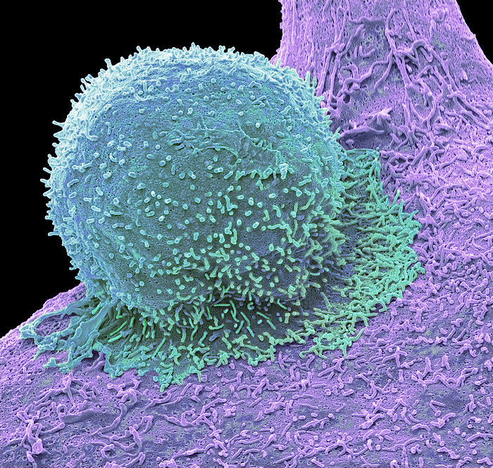 CAR T cell therapy, SEM CAR T cell therapy. Coloured scanning electron micrograph  SEM  of a T cell   cyan  and a breast cancer cell. CAR T cell therapy involves producing large quantities of specialised T cells on an individual basis for each patient. T cells are extracted from a patient s blood sample and reprogrammed to recognise a specific target protein on the patient s tumour cells. To achieve this, the T cells are infected with a harmless virus, which inserts a gene into the T cell s DNA that causes the T cell to produce a receptor on its surface that recognises a specific tumour protein. Large quantities of the reprogrammed T cells are grown in the lab before being injected back into the patient where they seek out the target protein on breast cancer cells and attack them. Magnification: x3600 when printed at 10 centimetres wide., by STEVE GSCHMEISSNER SCIENCE PHOTO LIBRARY