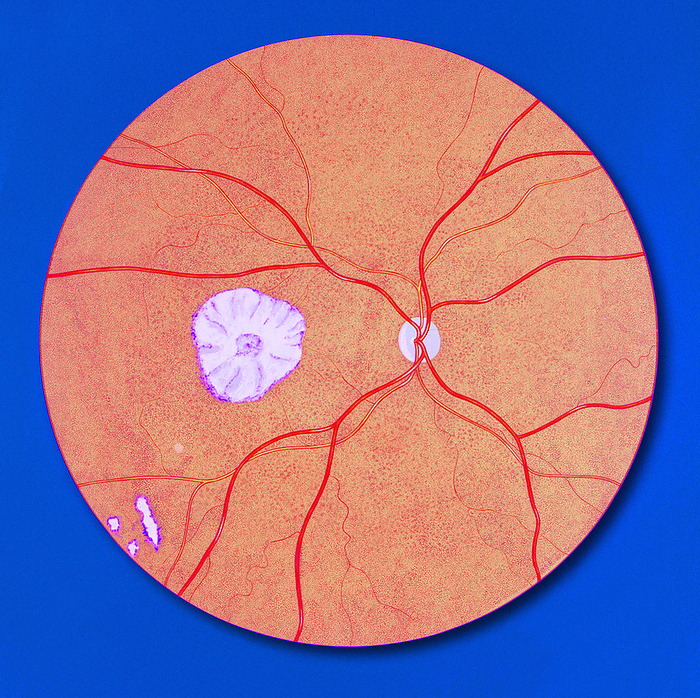 Fundoscopic view of CMV retinitis, illustration  Illustration showing a fundoscopic view of the right eye, revealing the retina, its optic nerve, blood vessels supplying the retina, and lesions caused by the cytomegalovirus, resulting in a case of cytomegalovirus  CMV  retinitis., by CDC John King SCIENCE PHOTO LIBRARY