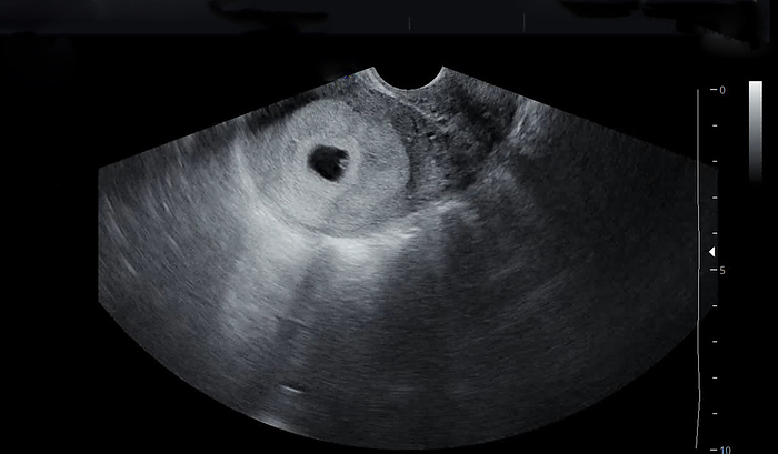Embryo at five weeks, ultrasound scan Transvaginal ultrasound of an embryo  centre, black oval  taken at five weeks and three days., by DR NAJEEB LAYYOUS SCIENCE PHOTO LIBRARY