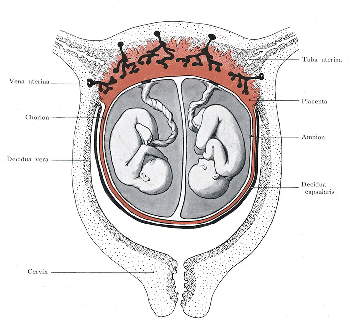 Twin foetuses, illustration Illustration of twin foetuses in utero that share a single common placenta  red  and chorionic sac  red  but separate amniotic cavities  grey . These twins arise from duplication of the inner cell mass of the early embryo that develops separately into two foetuses. Among twin pregnancies this arrangement occurs in about 70 percent of cases. From Kollmann, J.  1907  Handatlas der Entwicklungsgeschichte des Menschen, vol 1, Fig. 177. G. Fischer, Jena., by MICROSCAPE SCIENCE PHOTO LIBRARY
