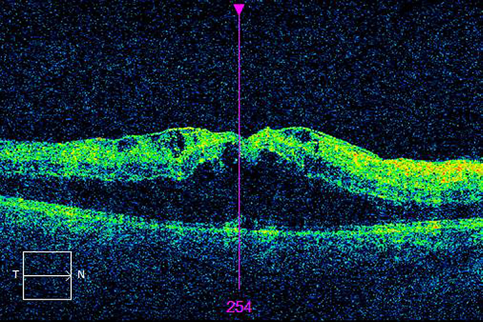Diabetic macular oedema, OCT scan Ocular coherence tomography  OCT  scan of a section through the retina of the right eye a 28 year old female patient showing diabetic macular oedema  DMO . DMO is a condition seen in people with diabetes, where leaky vessels cause fluid to build in the macula at the centre of the retina. It is the most common cause of sight loss in people with diabetes., by ALAN FROHLICHSTEIN SCIENCE PHOTO LIBRARY
