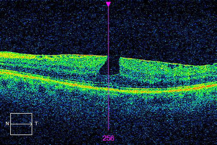 Macular pucker with lamellar hole, OCT scan Ocular coherence tomography  OCT  scan of a section through the retina of the left eye of a 64 year old male patient showing a macular pucker with lamellar hole  LMH . Macular pucker is scar tissue that has formed on the macula located at the centre of the retina. lamellar macular hole  LMH . LMH is a defect that goes part way through the macula  centre of the retina  leaving outer retinal layers intact.    , by ALAN FROHLICHSTEIN SCIENCE PHOTO LIBRARY