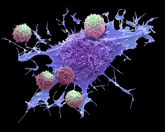 CAR T cell therapy, SEM  CAR  T cell therapy. Composite coloured scanning electron micrograph  SEM  of T cells and a lymphoma cancer cell  purple . T cells are a component of the body s immune system. Chimeric antigen receptor  CAR  T cell therapy takes T cells from a patient s bloodstream and reprograms them to recognize a specific protein found on lymphoma cells. The T cells are reintroduced to the patient s blood system where the find and attack the lymphoma cells. Early trials indicate that CAR T cell therapy is effective for the treatment of lymphoma in patients with no other good treatment options. Magnification: x3200 when printed at 10 centimetres high., by STEVE GSCHMEISSNER SCIENCE PHOTO LIBRARY