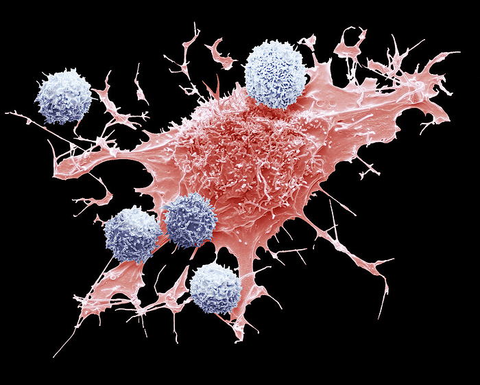 CAR T cell therapy, SEM  CAR  T cell therapy. Composite coloured scanning electron micrograph  SEM  of T cells and a lymphoma cancer cell  red . T cells are a component of the body s immune system. Chimeric antigen receptor  CAR  T cell therapy takes T cells from a patient s bloodstream and reprograms them to recognize a specific protein found on lymphoma cells. The T cells are reintroduced to the patient s blood system where the find and attack the lymphoma cells. Early trials indicate that CAR T cell therapy is effective for the treatment of lymphoma in patients with no other good treatment options. Magnification: x3200 when printed at 10 centimetres high., by STEVE GSCHMEISSNER SCIENCE PHOTO LIBRARY