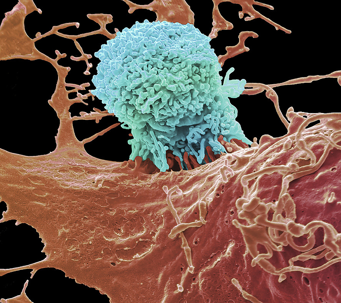 Natural killer cell, SEM Coloured scanning electron micrograph  SEM  of a natural killer cell  NK   cyan  attacking a liver cancer cell. Natural killer cells, also known as large granular lymphocytes  LGL , are a type of cytotoxic Natural killer cells, also known as large granular lymphocytes  LGL , are a type of cytotoxic lymphocyte critical to the innate immune system that belong to the rapidly expanding family of known innate lymphoid cells  ILC  and represent 5  0  of all circulating lymphocytes in humans. NK cells provide rapid responses to virus infected cells and other intracellular pathogens acting at around 3 Magnification x 9000 at 10cm wide. Specimen courtesy of the Maini Lab. UCL. by STEVE GSCHMEISSNER SCIENCE PHOTO LIBRARY