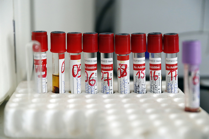 Blood samples Blood samples, Benin., by Pascal Deloche Godong Universal Images Group SCIENCE PHOTO LIBRARY