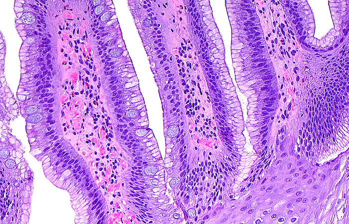 Light micrograph of intestinal metaplasia in the oesophagus. Barrett鈥檚 Oesophagus is intestinal metaplasia that occurs in the oesophagus, and is Haematoxylin and eosin stained tissue section. Magnification: 100x when printed at 10 cm ., by ZIAD M. EL-ZAATARI/SCIENCE PHOTO LIBRARY