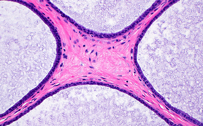 Benign cysts in breast tissue, light micrograph Light micrograph of microcysts  very small cysts best seen microscopically  in a human breast. The picture shows the intersection of four separate cysts, each of which is lined by a single layer of cells  dark blue  and containing myxoid  light blue staining  substance. The pink material extending from the centre to the four corners of the picture is the connective tissue in between the four cysts. Haematoxylin and eosin stained tissue section. Magnification: 200x when printed at 10cm., by ZIAD M. EL ZAATARI SCIENCE PHOTO LIBRARY