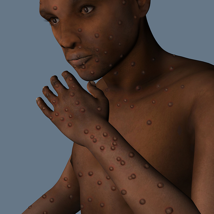 Monkeypox infection, illustration Patient with monkeypox infection, computer illustration. Monkeypox is a zoonotic virus from the Poxviridae family that causes monkeypox, a pox like disease. This virus, which is found near rainforests in Central and West Africa causes disease in humans and monkeys, although its natural hosts are rodents. It is capable of human to human transmission. In humans it causes fever, swollen glands and a rash of fluid filled blisters. It is fatal in 10 per cent of cases., by FERNANDO DA CUNHA SCIENCE PHOTO LIBRARY