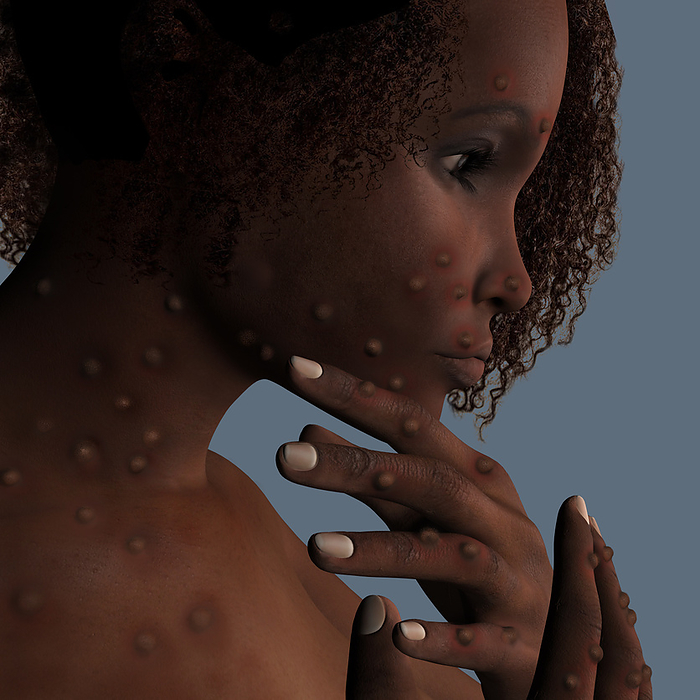 Monkeypox infection, illustration Patient with monkeypox infection, computer illustration. Monkeypox is a zoonotic virus from the Poxviridae family that causes monkeypox, a pox like disease. This virus, which is found near rainforests in Central and West Africa causes disease in humans and monkeys, although its natural hosts are rodents. It is capable of human to human transmission. In humans it causes fever, swollen glands and a rash of fluid filled blisters. It is fatal in 10 per cent of cases., by FERNANDO DA CUNHA SCIENCE PHOTO LIBRARY