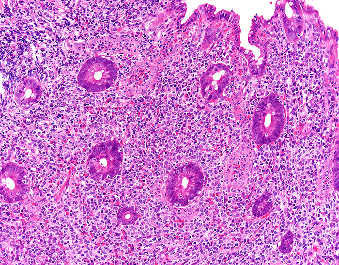 Mantle cell lymphoma, light micrograph Mantle cell lymphoma, light micrograph. Mantle cell lymphoma is an aggressive B cell lymphoma composed of small to medium sized monomorphic lymphoid cells with irregular, indented, or clefted nuclei resembling centrocytes. It has also been known as mantle zone lymphoma, centrocytic lymphoma, diffuse small cleaved cell lymphoma, and intermediate lymphocytic lymphoma. It makes up about 2.5  of non Hodgkin lymphomas in the US. The image shows mantle cell lymphoma involving the spleen., by WEBPATHOLOGY SCIENCE PHOTO LIBRARY