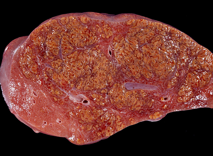 Hepatocarcinoma Gross specimen of a human liver affected by a hepatocellular carcinoma  HCC . The tumour appears as multiple nodules that occupy a large part of the slice, compressing the normal hepatic parenchyma. At bottom is a portion of unaffected liver. Hepatocellular carcinoma  HCC  is the most common type of primary liver cancer in adults., by JOSE CALVO   SCIENCE PHOTO LIBRARY