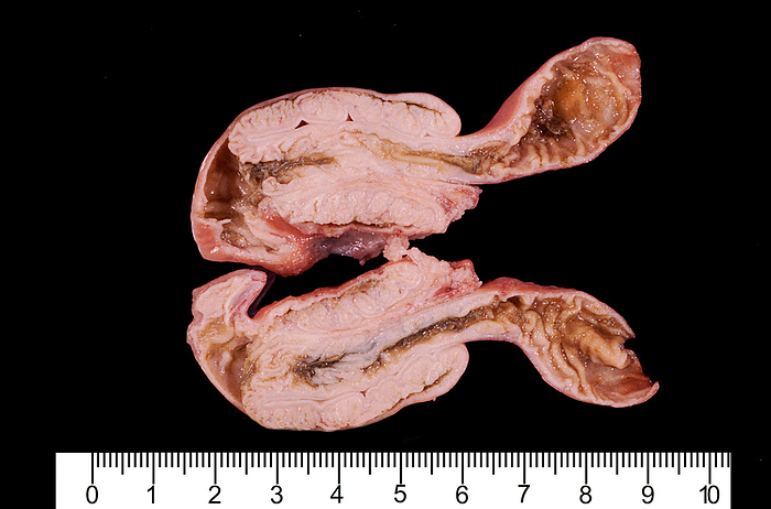 Human small bowel intussusception Gross specimen of a human small bowel affected by an intussusception, a medical condition in which a part of the intestine folds into the section immediately ahead of it. The actual size can be determined with the rule below., by JOSE CALVO   SCIENCE PHOTO LIBRARY