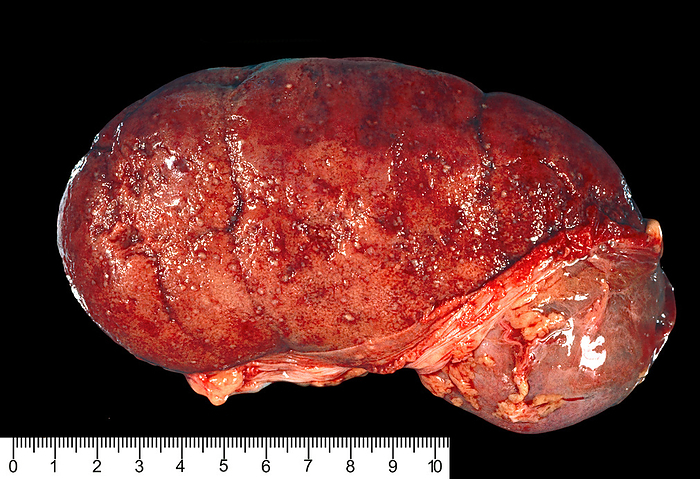 Acute pyelonephritis Gross specimen showing a human kidney with acute pyelonephritis. The capsule has been stripped off except at the upper pole to show the surface of the renal cortex filled with focal pale abscesses. The actual size can be determined with the rule below., by JOSE CALVO   SCIENCE PHOTO LIBRARY