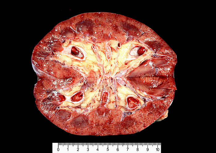 Acute pyelonephritis Gross specimen showing a human kidney with acute pyelonephritis. The capsule has been peeled except at the upper pole to show the surface of the renal cortex filled with focal pale abscesses. The actual size can be determined with the rule below., by JOSE CALVO   SCIENCE PHOTO LIBRARY
