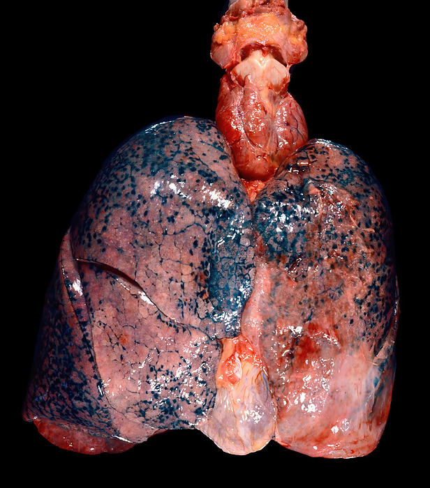 Anthracosis and thyroid goitre Gross specimen showing human lungs, heart, trachea and larynx. The lungs show dark blue pigmentation  anthracosis , a disease caused by urban air pollution or tobacco smoke. Anthracosis occurs when the lung s capacity to remove coal particles is exceeded and the dust accumulates. Under the thyroid cartilage, the thyroid gland is very enlarged  goitre ., by JOSE CALVO   SCIENCE PHOTO LIBRARY