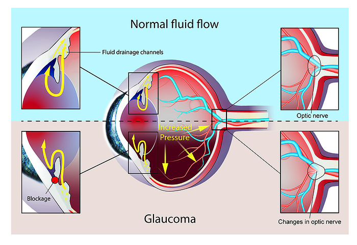 Normal eye and eye with glaucoma, illustration Illustration of a section of an eye showing normal fluid flow in drainage channels  top  and glaucoma  bottom , where drainage channel blockages cause increased pressure within the eye. This increased pressure results in optic nerve damage and visual field loss., by JOE BROCK, RESEARCH ILLUSTRATION, FRANCIS CRICK INSTITUTE SCIENCE PHOTO LIBRARY