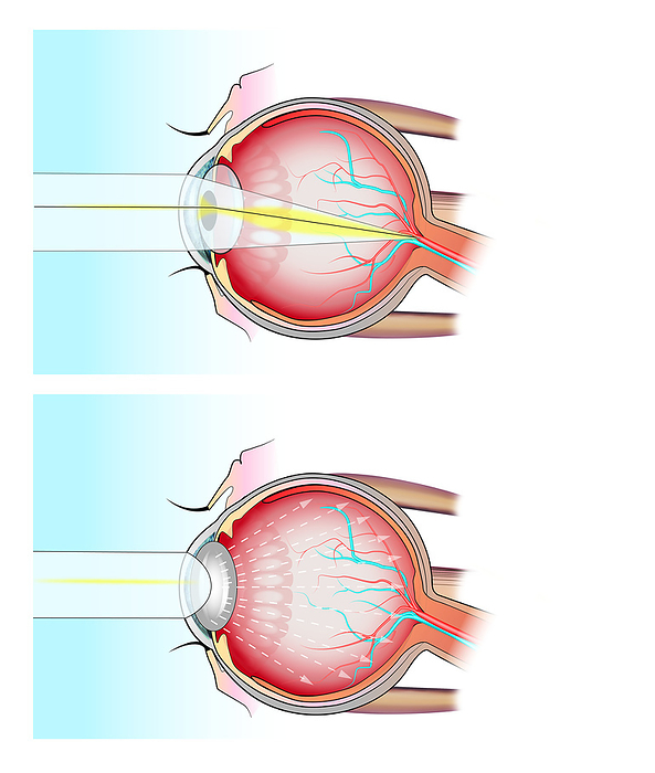 Normal eye and eye with cataract, illustration Illustration showing in side sectional view the distribution and effect of light through the lens of a healthy human eye  top  and an eye with cataracts  bottom . Cataract is a condition in which the lens of the eye loses its transparency. They are a natural feature of ageing, but can also be caused by injury to the eye or certain diseases, such as diabetes. It leads to progressive loss of vision and may result in blindness., by JOE BROCK, RESEARCH ILLUSTRATION, FRANCIS CRICK INSTITUTE SCIENCE PHOTO LIBRARY