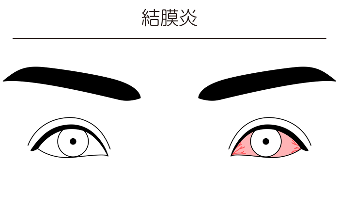 Medical Clipart, Line Drawing Illustration of Eye Disease and Conjunctivitis