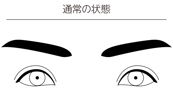 Medical illustration, eye disease and strabismus Illustrative line drawing illustration of normal conditions