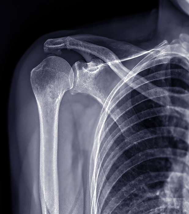Fractured shoulder, X ray Fractured shoulder, X ray., by SAMUNELLA SCIENCE PHOTO LIBRARY