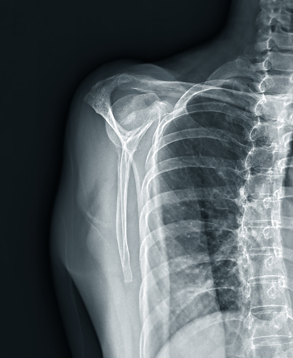 Fractured shoulder, X ray Fractured shoulder, X ray., by SAMUNELLA SCIENCE PHOTO LIBRARY