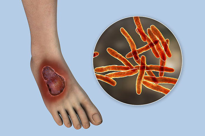 Buruli ulcer and Mycobacterium ulcerans, illustration Illustration of a buruli ulcer on a foot with a close up view of Mycobacterium ulcerans, the bacterium that causes the disease., by KATERYNA KON SCIENCE PHOTO LIBRARY
